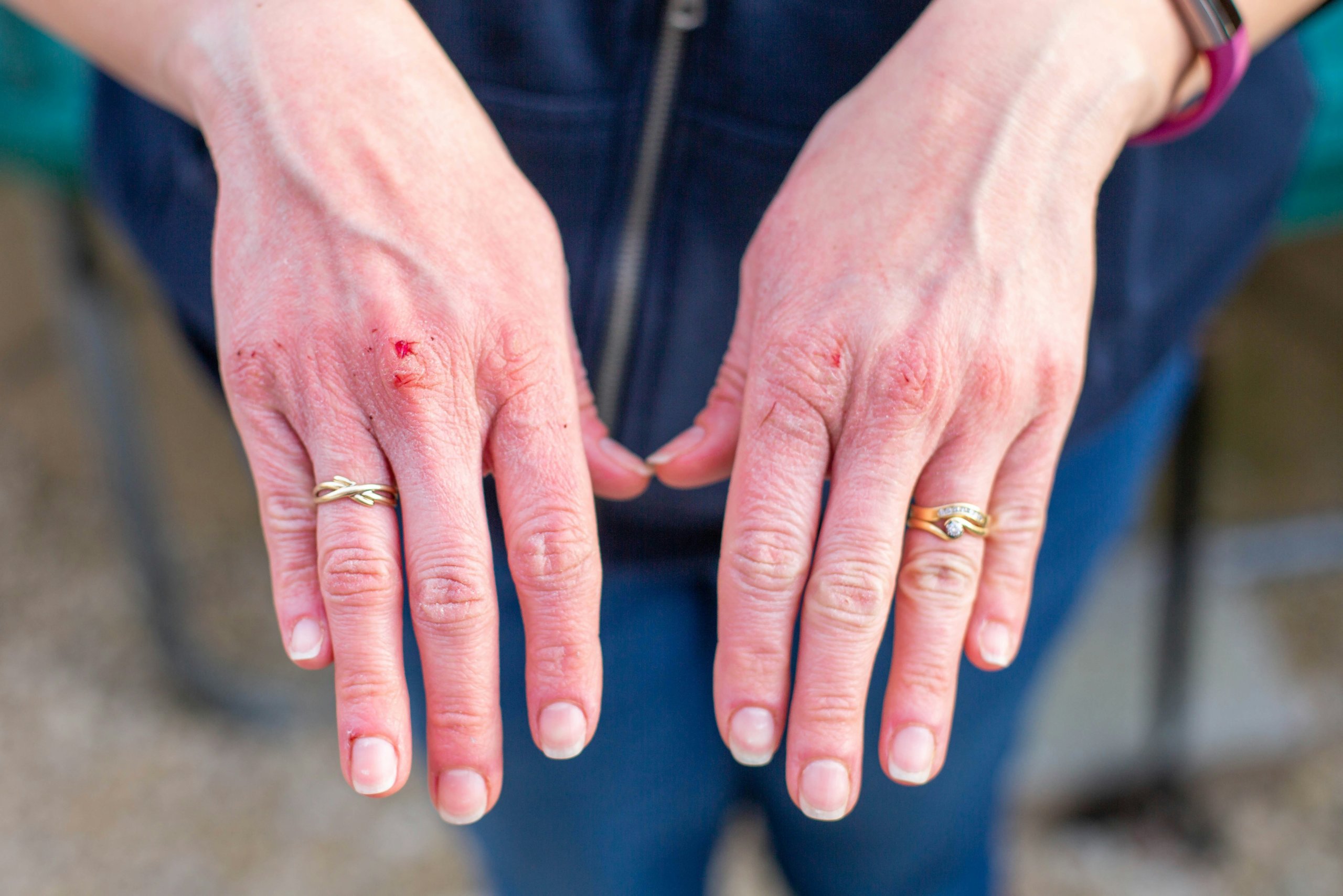 glochid dermatitis