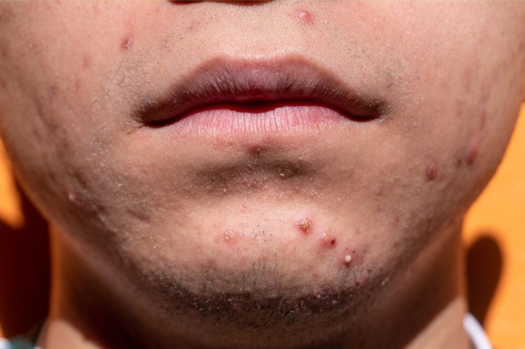 man with acne